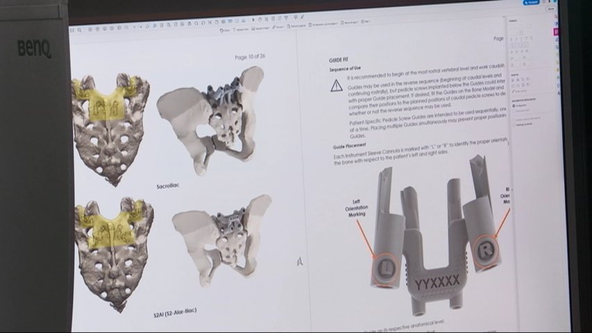 Firefly trabaja con modelos y guías 3D para cirugías de columna